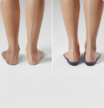 Rear view of legs standing without and with supportive orthotics